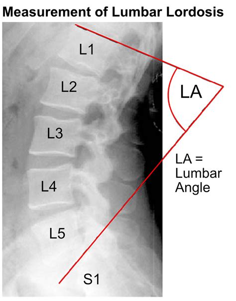 Lumbar lordosis or hyperlordosis - Back Care Clinic