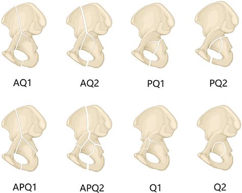 A new classification for quadrilateral plate fracture of acetabulum - Injury