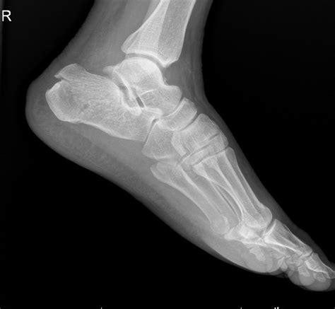 Calcaneus Fractures - Trauma - Orthobullets