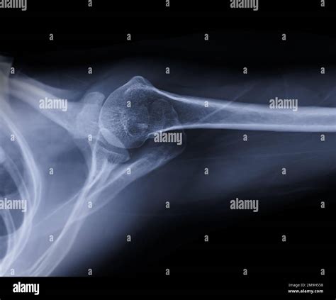 X-ray Shoulder joint shoulder transaxillary view for diagnosis fracture ...