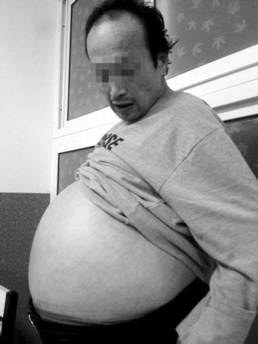 男子肚子大像临盆孕妇 专家会诊找不到原因(图)|肚子|孕妇|会诊_新浪新闻