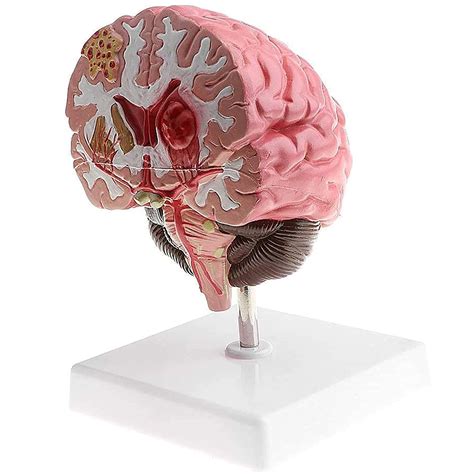 Buy Pathological Brain Structure Anatomy Model, Life Size Human Brain ...