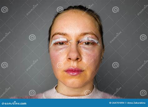 Woman Face after Plastic Surgery, Blepharoplasty Operation, Swelling Eye Bags, Incisions with ...