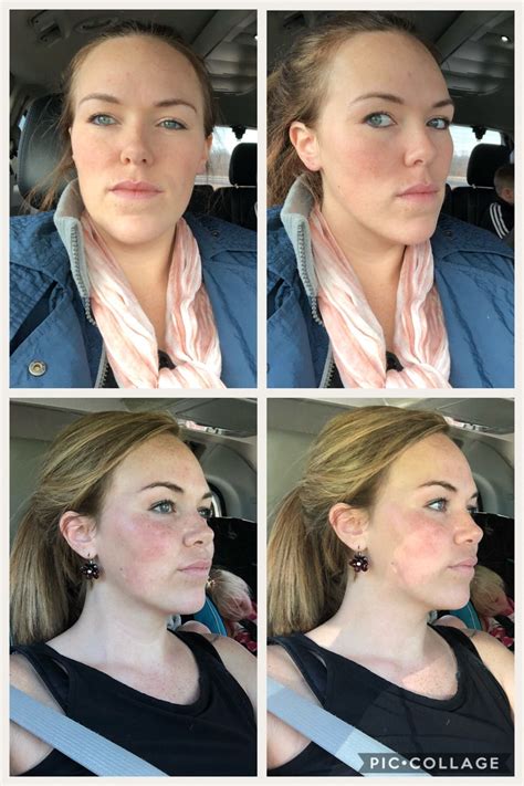 Corrective and orthognathic jaw surgery dr richard w joseph – Artofit