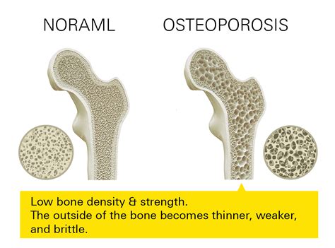 Osteoporosis - Symptoms, Diagnosis & Treatment - Marley Drug Pharmacy