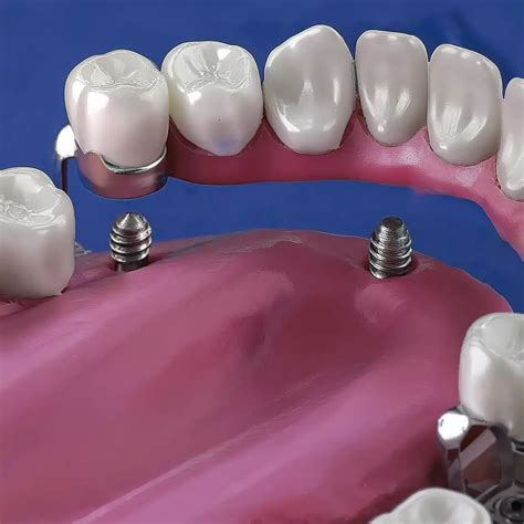 Implantes dentales All-on-4: Boca completa