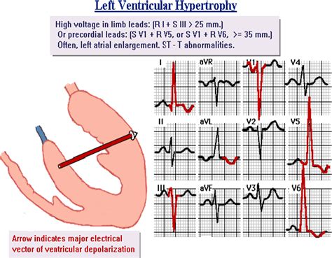 Ventricular Hypertrophy