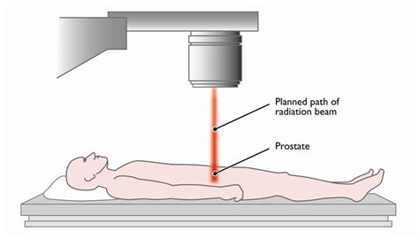 Prostate Radiation Simulation 的图像结果