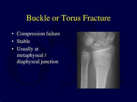 PPT - **Fracture Assessment & Treatment in Skeletally Immature Patients** PowerPoint ...