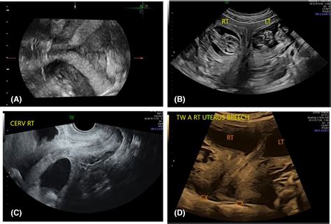 Dicavitary twin pregnancy in patient with bicornuate bicollis uterine ...