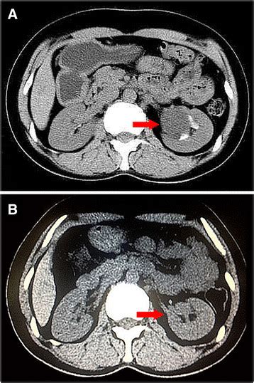 Kuvatulokset haulle parapelvic cyst kidney