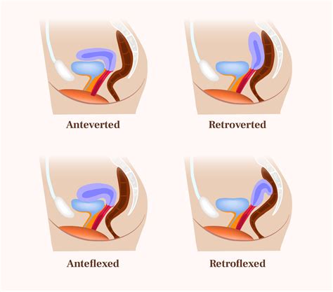 Retroverted Uterus Cervix Position