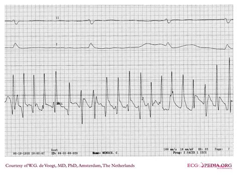 File:DVA0189.jpg - ECGpedia