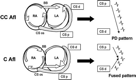 Different Patterns of Interatrial Conduction in Clockwise and Counterclockwise Atrial Flutter ...