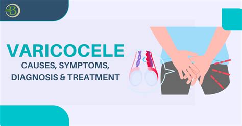 Varicocele: Causes, Symptoms, Diagnosis & Treatment - Bharat Homeopathy