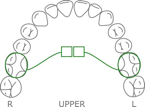 Image result for Mini RPE Expander