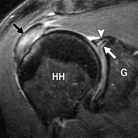 Superior Labral Anteroposterior Lesions of the Shoulder: Part 2 ...
