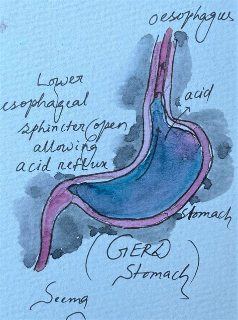 What Causes Too Much Burping?. In my case, it was acid reflux | by Dr ...