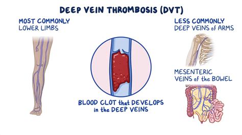 Deep vein thrombosis: Clinical sciences - Osmosis Video Library