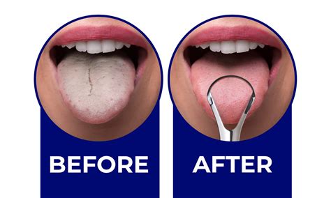 Tongue Scraper: Before and After Results Backed by Research