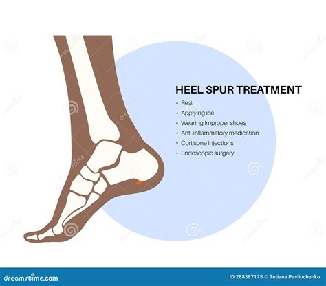 Heel Bone Fracture. Calcaneal Fracture Cartoon Vector | CartoonDealer.com #320469429
