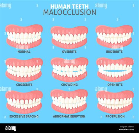 Different human teeth malocclusion types front view set Stock Vector ...
