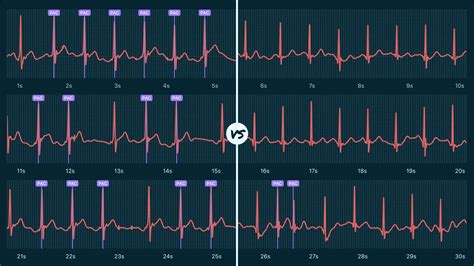 Ectopic Atrial Rhythm Vs. Premature Atrial Contraction (Couplet) on Your Watch ECG | Qaly