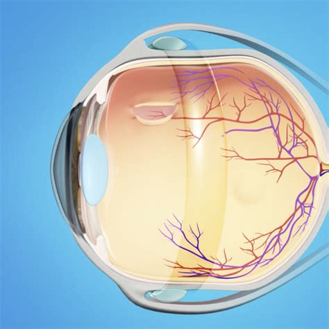Scleral Buckling Surgery for Retinal Detachment - Dr Rehman Siddiqui