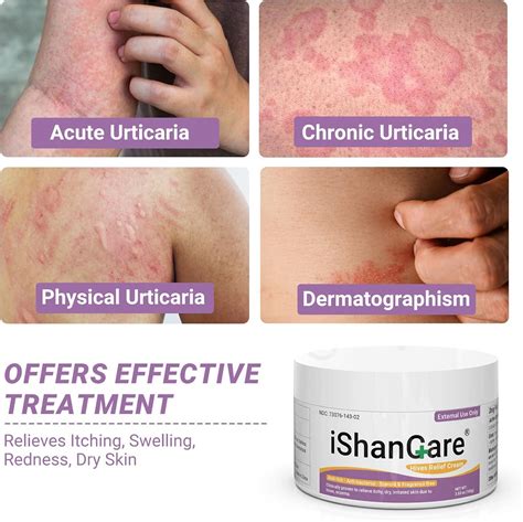 Urticaria Cream - Fast Relief for Hives Allergic Rashes & Itchy Skin | All-Natural Herbal ...