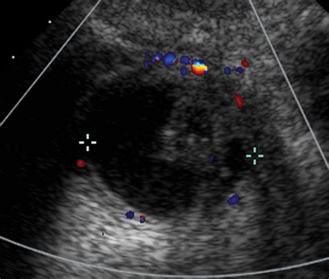 Urethral Diverticulum Ultrasound
