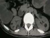 Acute Intestinal Obstruction in Adults Due to Ladd's Band