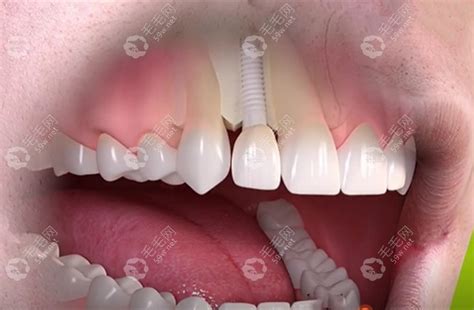 种植牙包括哪些费用和材料?口腔种植费用明细清单给你答案 - 口腔健康 - 毛毛网