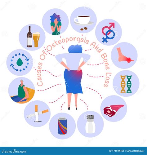 Causes of Osteoporosis and Bone Loss Stock Illustration - Illustration of human, genetics: 171594466