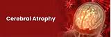Cerebral Atrophy: Causes, Symptoms, Diagnosis, Treatment