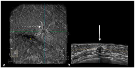 Pros and Cons for Automated Breast Ultrasound (ABUS): A Narrative Review