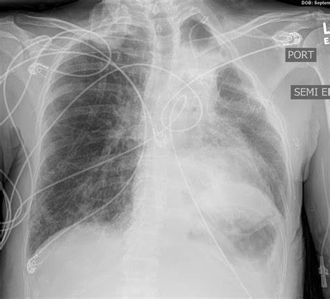 Finding Lungs Kerley Lines | The Common Vein