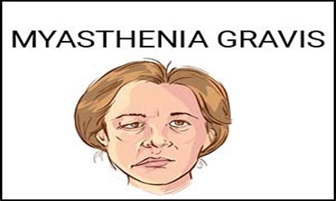 Zilucoplan found effective in generalized myasthenia gravis in JAMA study