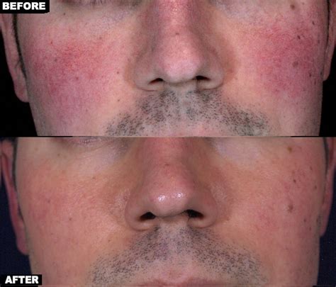 Rosacea Treatment NYC & Manhattan | UnionDerm