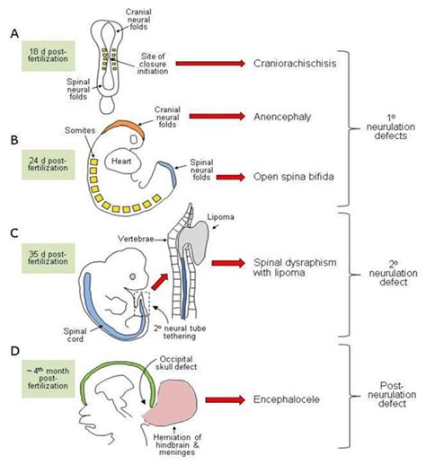 Image result for Neural Tube Defects Causes
