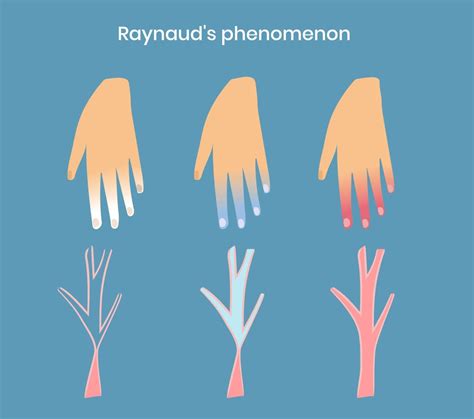 Raynaud's Syndrome - Symptoms, Causes, And Treatment