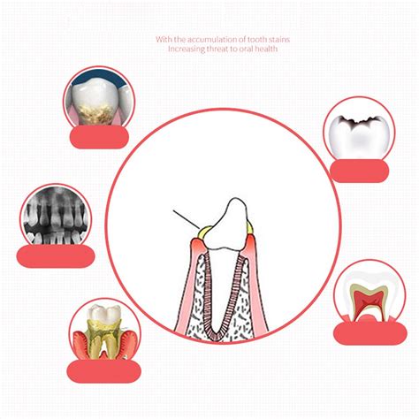 Fabater Plaque Disclosing Agent, 60ml Dental Plaque India | Ubuy