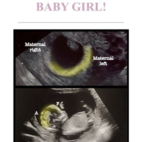 Confirmed Boy and Girl Ultrasound Scans - A Collection of Boy and Girl ...