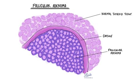 Follicular adenoma in the thyroid gland - MyPathologyReport.ca