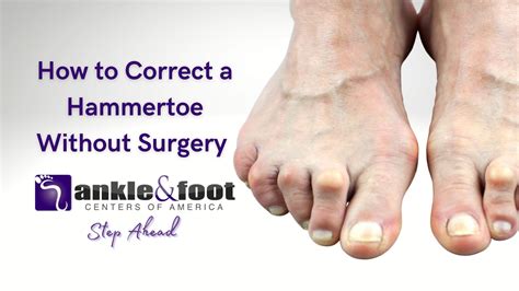 How To Fix Hammer Toe Without Surgery: Easy Ways