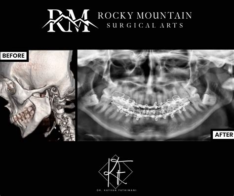 Facial Trauma Surgery Lone Tree, CO | Rocky Mountain Surgical Arts