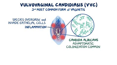 Vulvovaginal candidiasis: Clinical sciences - Osmosis Video Library