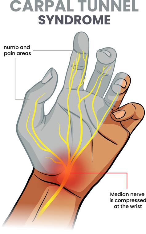 illustration of carpal tunnel syndrome 24318127 Vector Art at Vecteezy