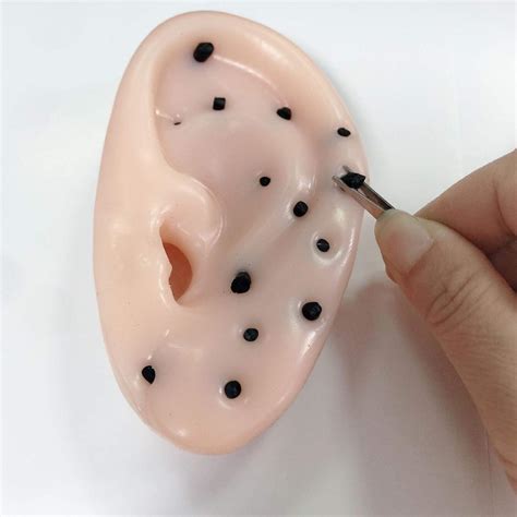 Blackhead In Ear
