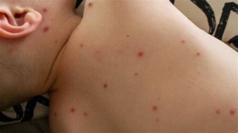 As US Measles Cases Climb To Nearly 1,200, Over 3% Of The Infected ...