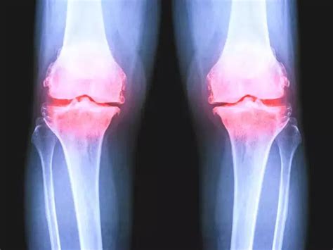 Are Weight-Bearing Knee Digital Radiographs better for assessment of ...